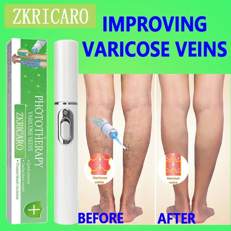 Powerful laser therapy improves moderate varicose veins, relieves pain and improves circulation in men and women